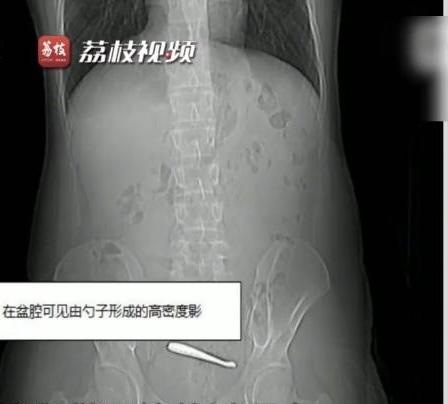 28岁小伙腹痛，CT查出肠道内卡着2把勺子。
近日，江苏南京一名28岁男子因腹痛