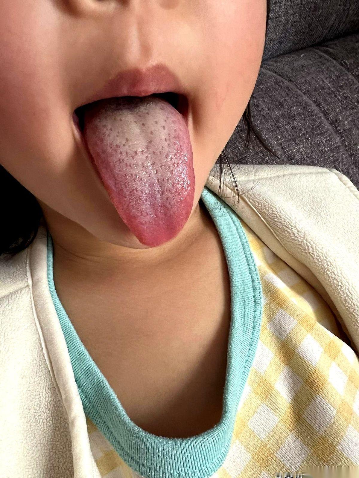 跟娃的感冒打了一仗，感觉自己像个新兵蛋子，被耍得团团转。
烧到39度多，小脸通红