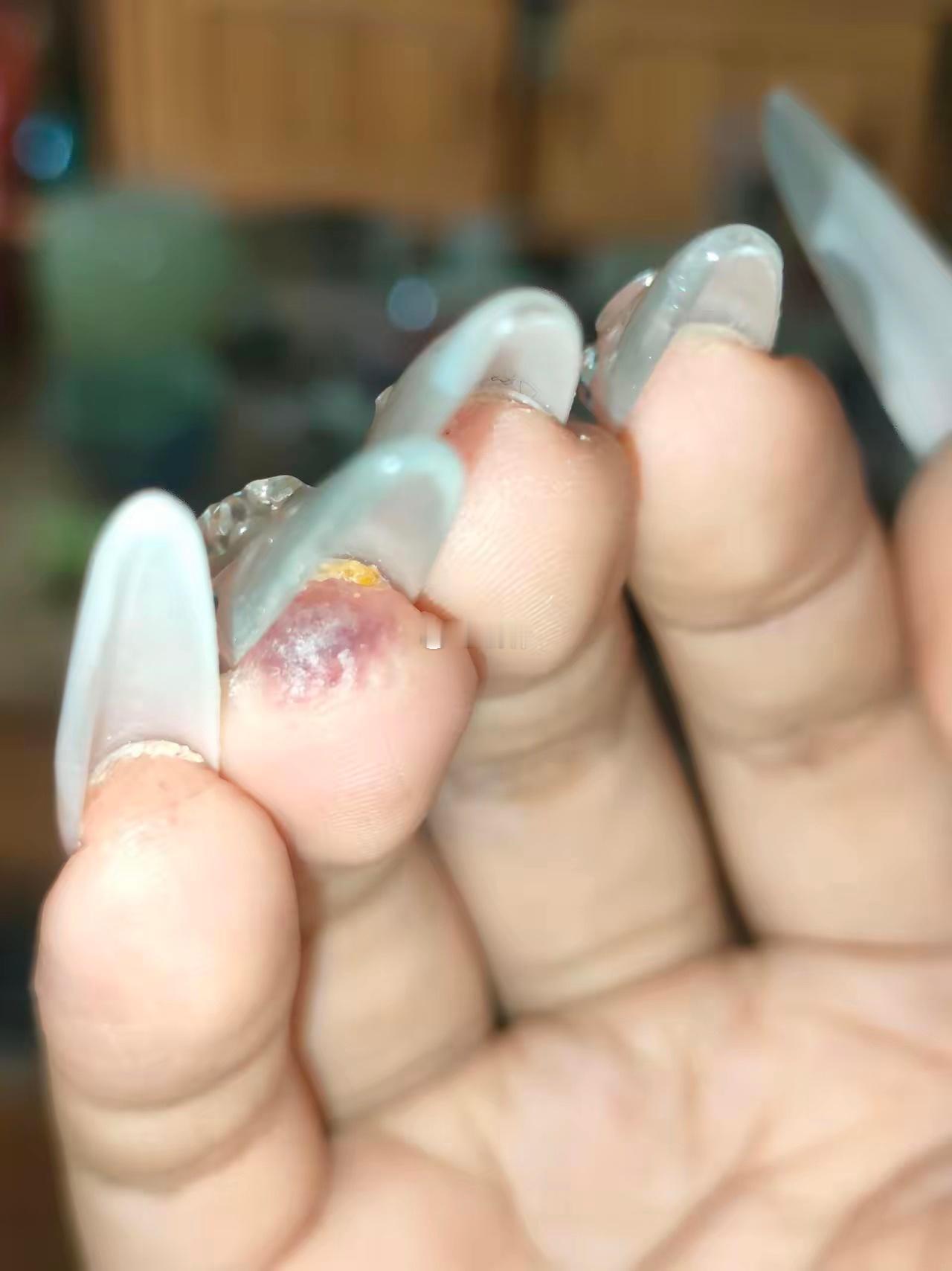求助高考完和朋友去做美甲，刚开始指甲盖周围有点痒，今天变成这样了 