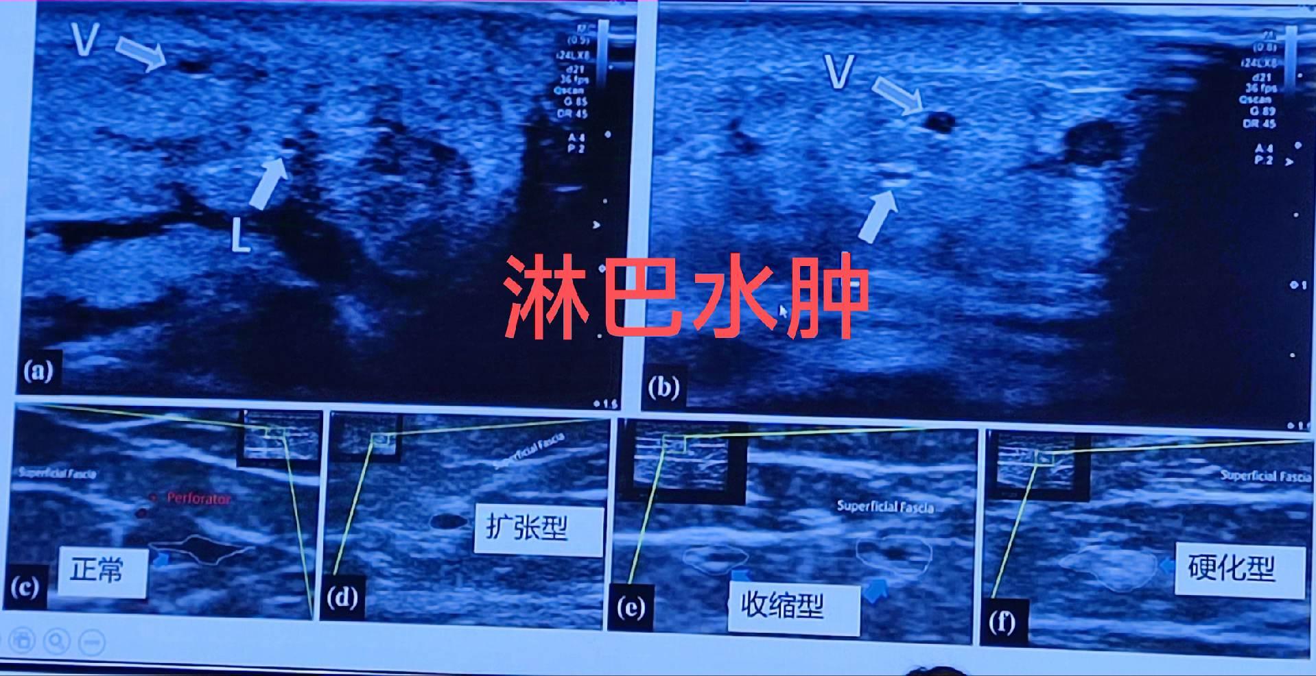 淋巴水肿超声。