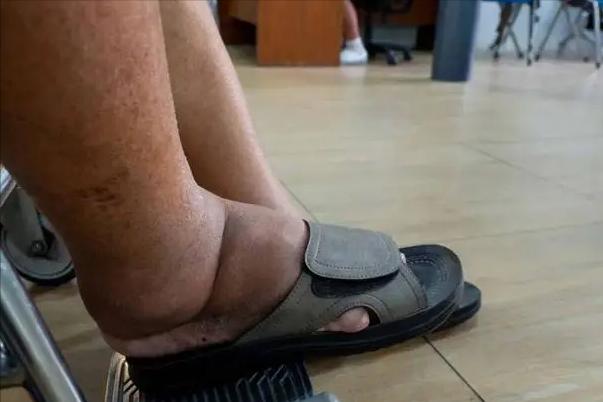 血栓疾病，老年人应如何应对？医生反复叮嘱：若不想疾病找上门，多坚持这几个习惯
