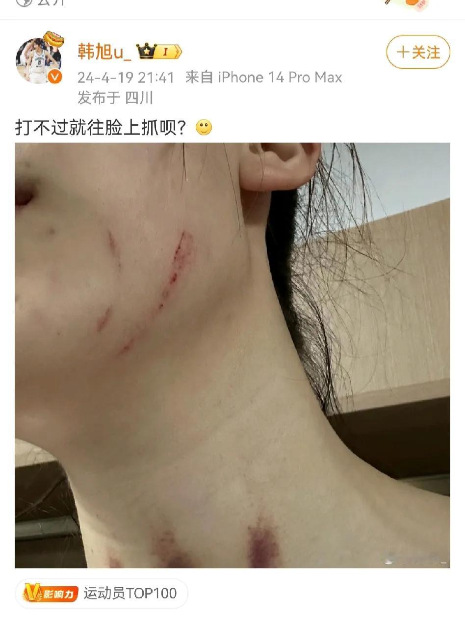 韩旭发文抱怨内蒙古女篮对自己动作过大，打不过就往脸上抓，并晒出脸上的抓痕。

看