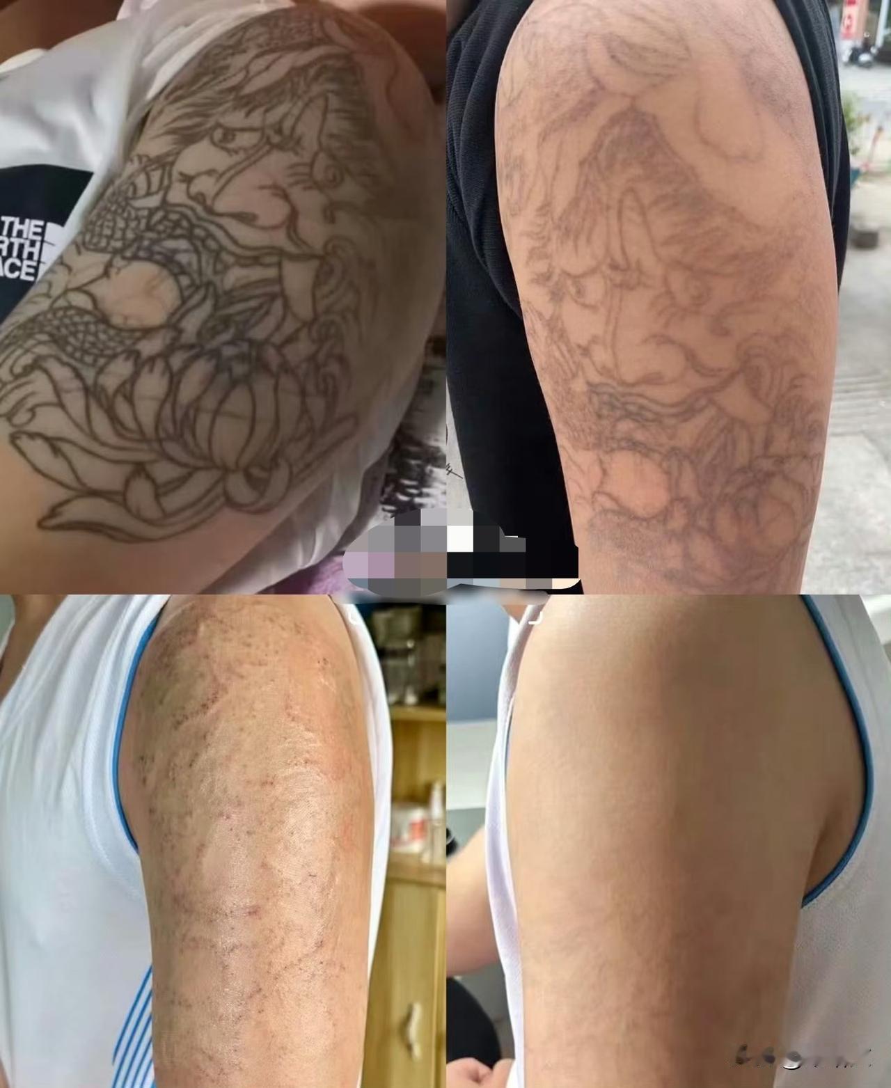 1500纹的身15000洗！姑娘痛到发抖：这哪是祛疤，是扒层皮
 
“纹身150