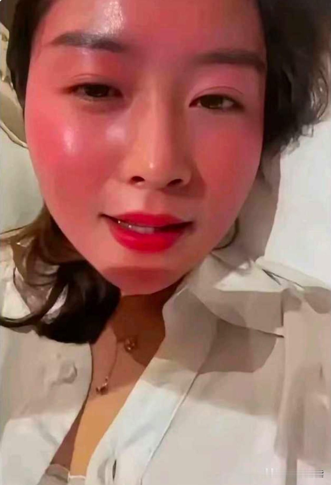 哈哈，见过喝酒上脸的，但没见过喝酒这么上脸的啊！这是严重的酒精过敏体质吗？