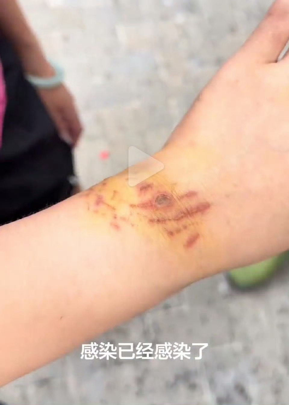 女子为出片生理期潜水被鲨鱼咬伤 就离谱，这心也太大了吧本地医院就简单处理了下，她