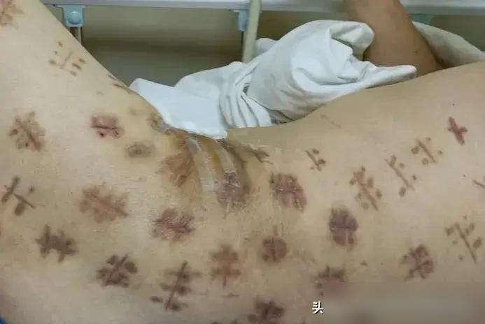 39岁肛周会阴坏死筋膜炎患者在ICU，他妻子多次添加我的微信，但我不能通过；
