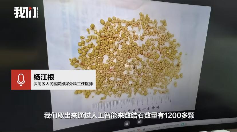 深圳一78岁大爷膀胱里竟藏着"珍珠奶茶"?医生手术取出上千颗!
这可不是危言耸听