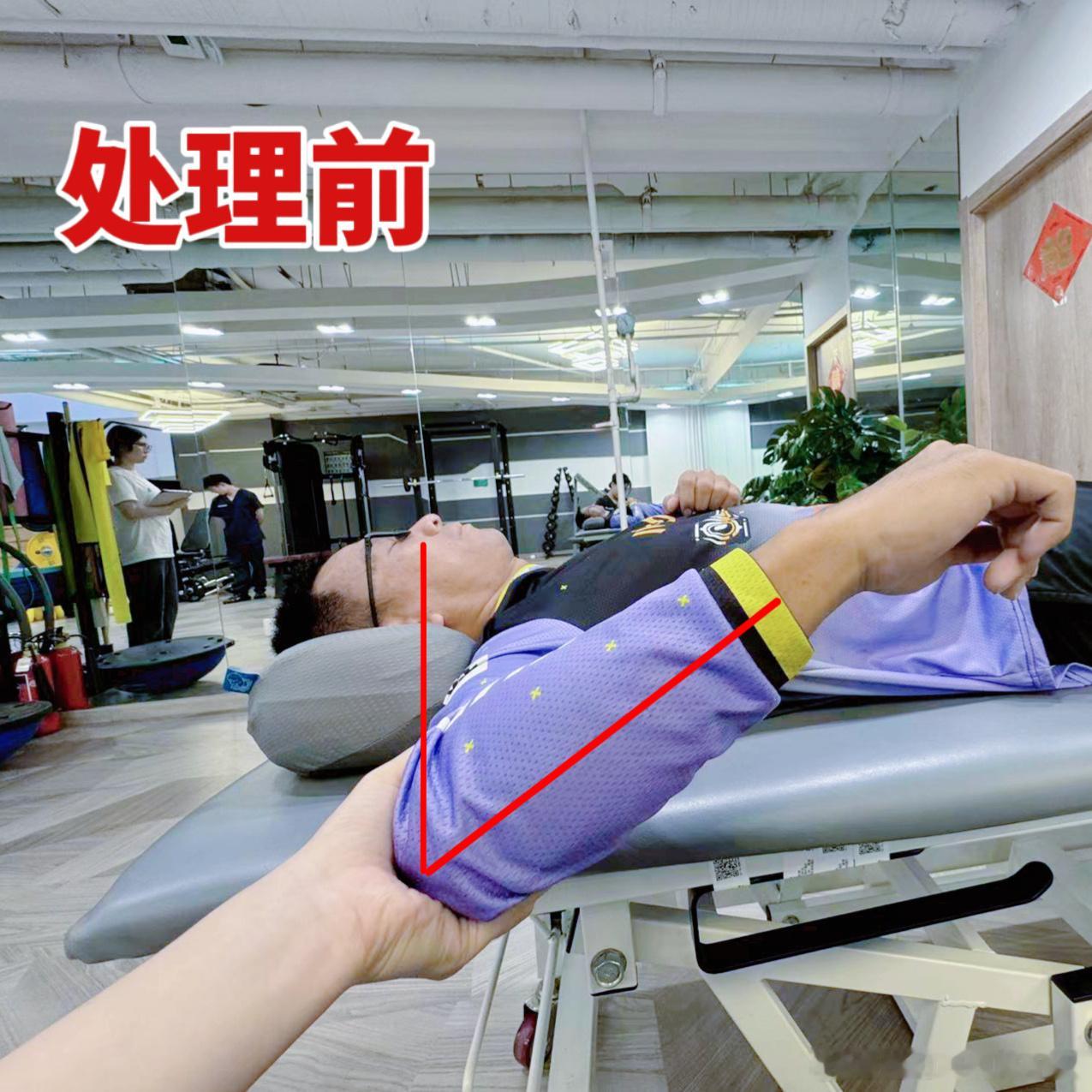 肩关节内旋活动度——处理前vs处理后，来看对比在北京华腾店治疗的大哥，肩关节疼痛