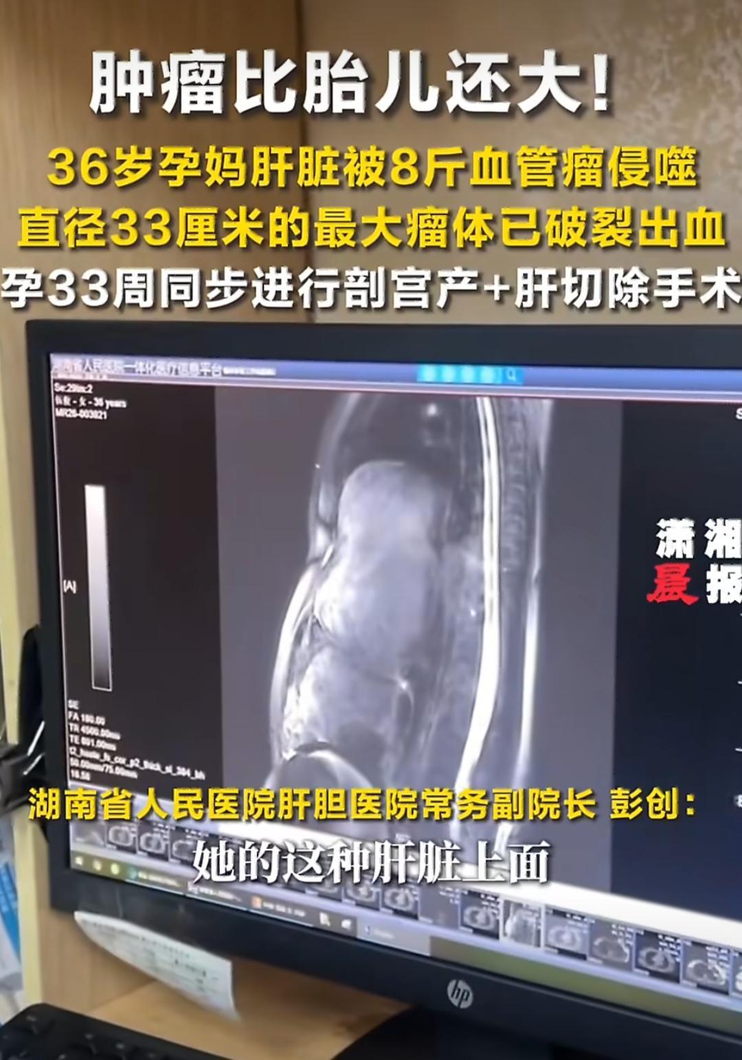 在湖南，36岁的孕妈小美（化名）遇到了一件特别凶险的事，她怀着33周的宝宝，肝脏