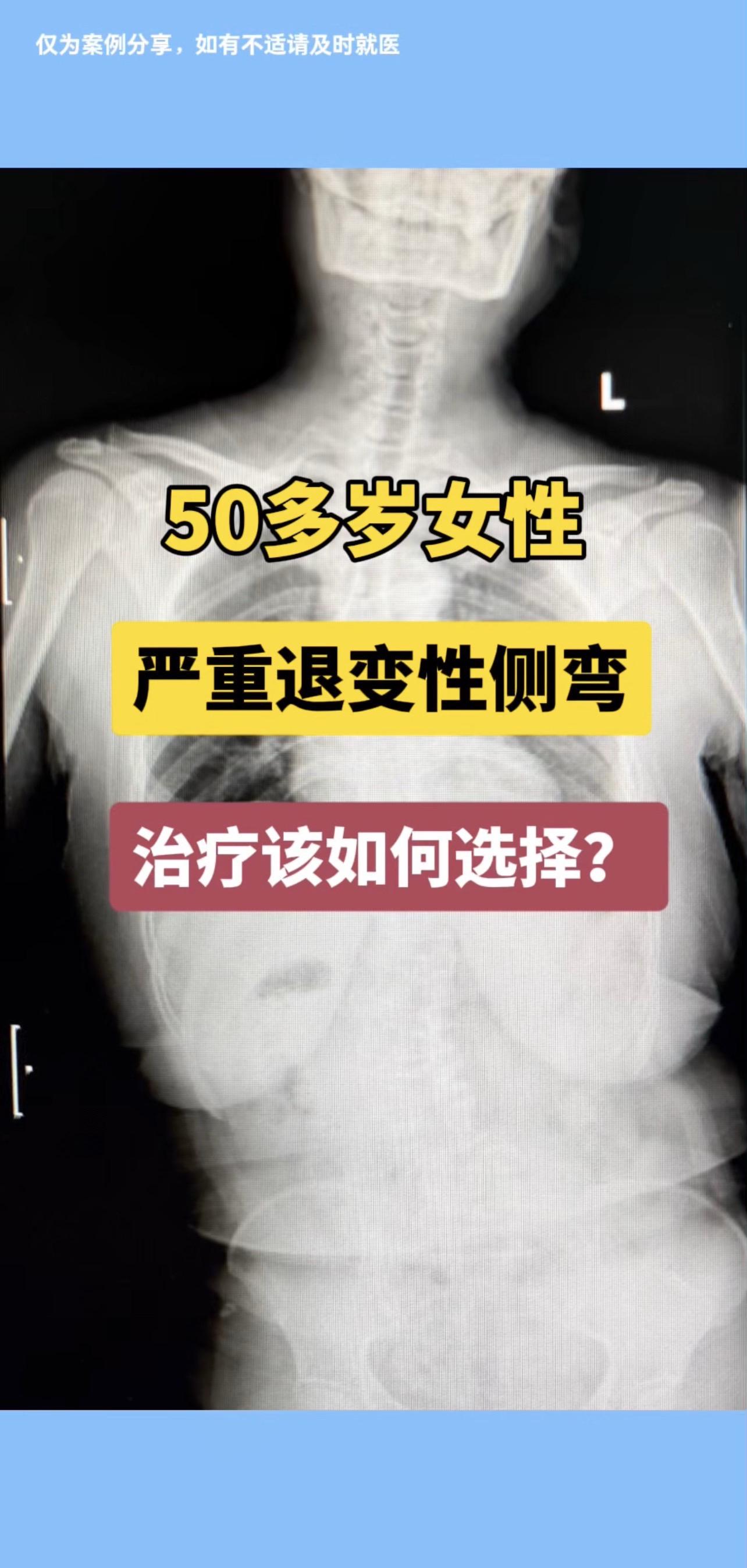 50多岁女性，行走30米左右腰疼伴左下肢疼痛严重，需休息后才能缓解，严...