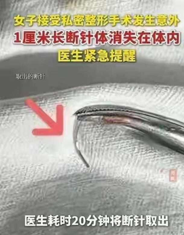 35岁女子去做私处紧缩，
缝针断在肉里，
医生徒手掏了半小时没找着3万买罪受！一