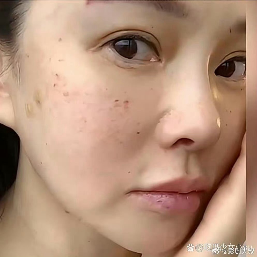 伊能静大方晒出自己的打针照片，果然，女明星为了容颜不老都很拼 ​​​