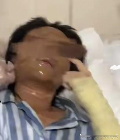 湖南女主播遇“夺命快递”：未拆封就炸，眼睛肿成一条缝
 
湖南永州那个29岁的户