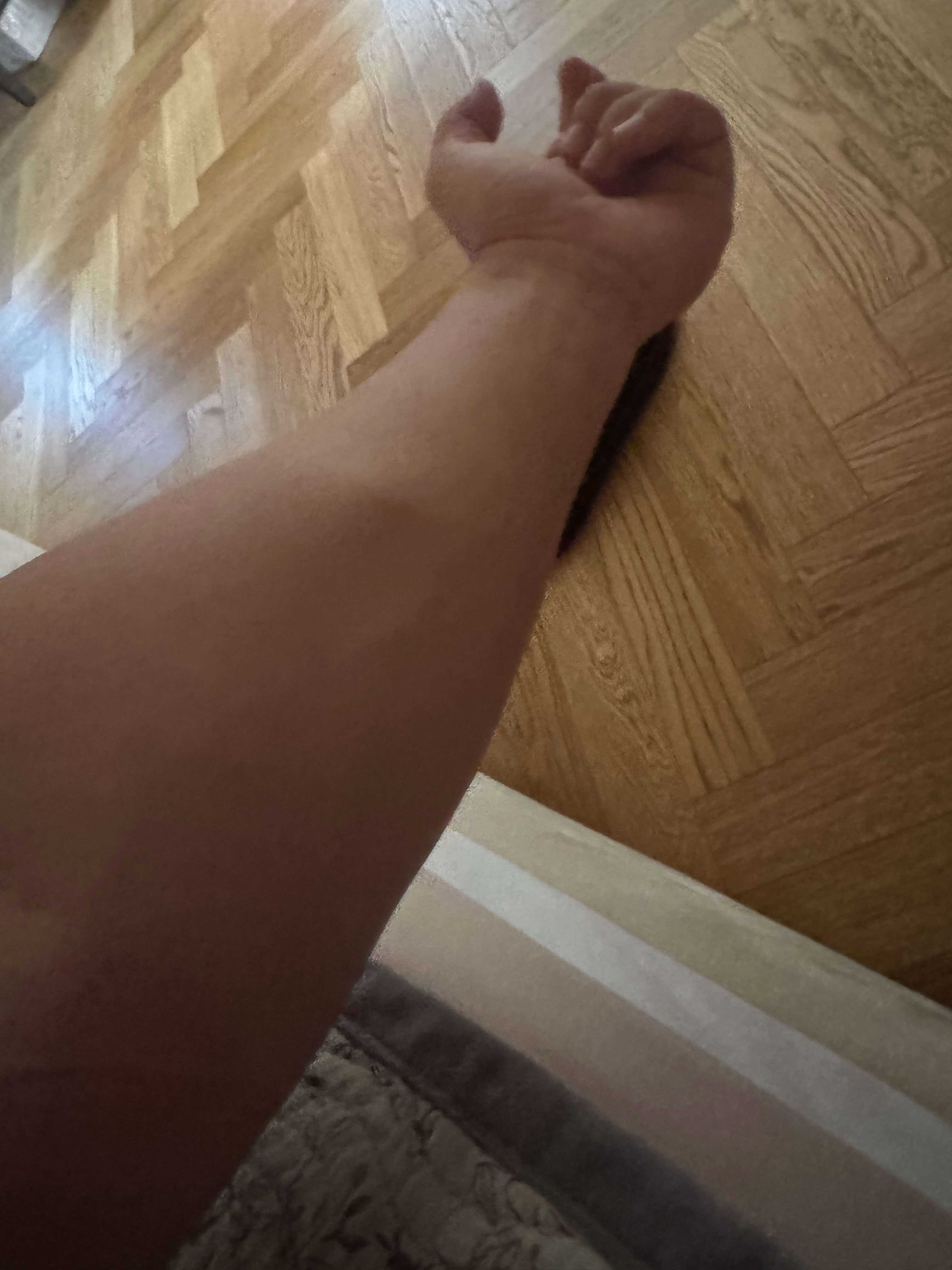 早上起的这个包，去医院看了看。医生给我一顿狂按，按回去了。哈哈 ​​​