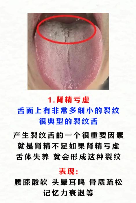舌头有裂纹，别不当回事！四种体质信号，教你对症调理