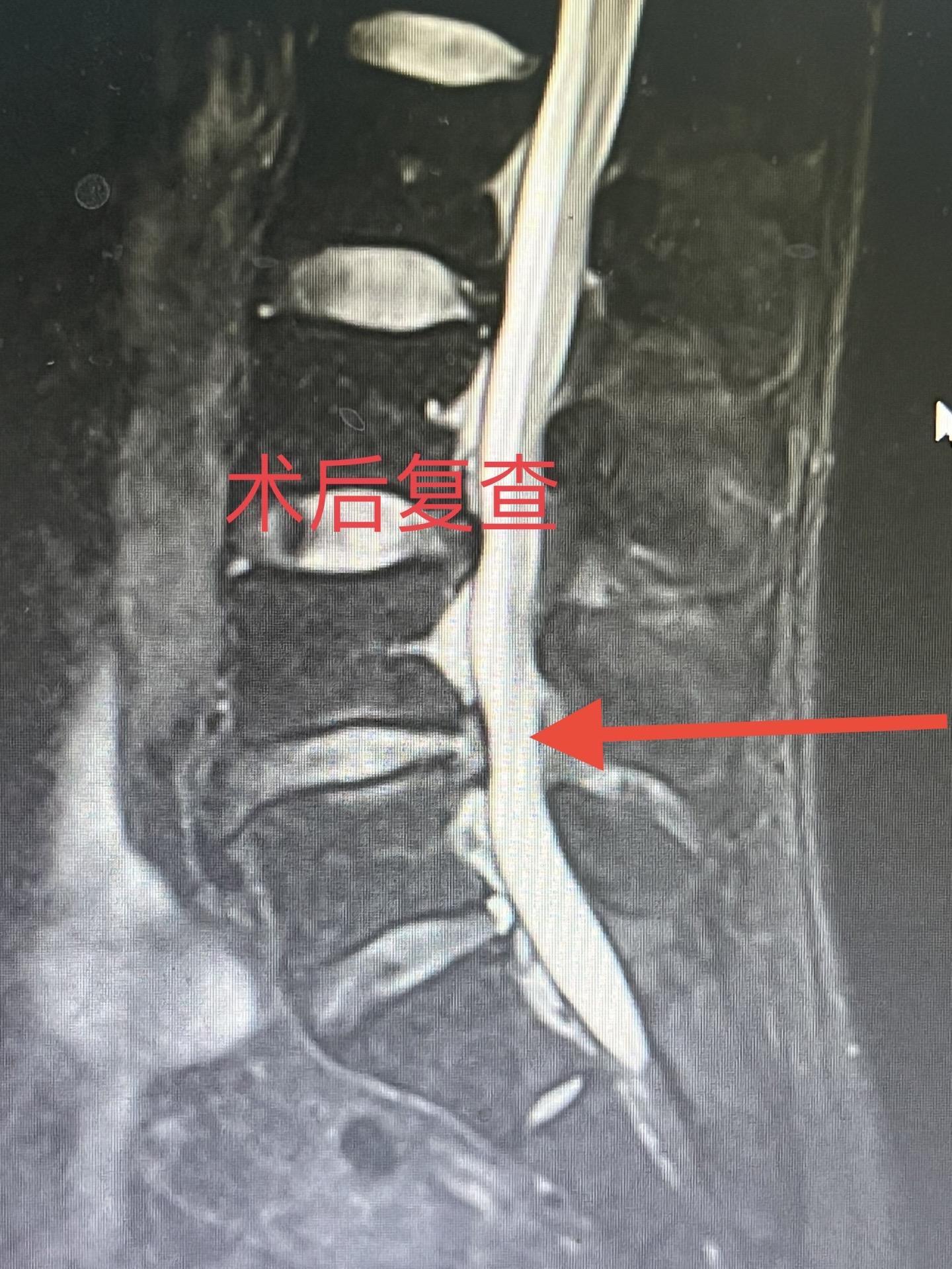 椎间盘突出内镜复查