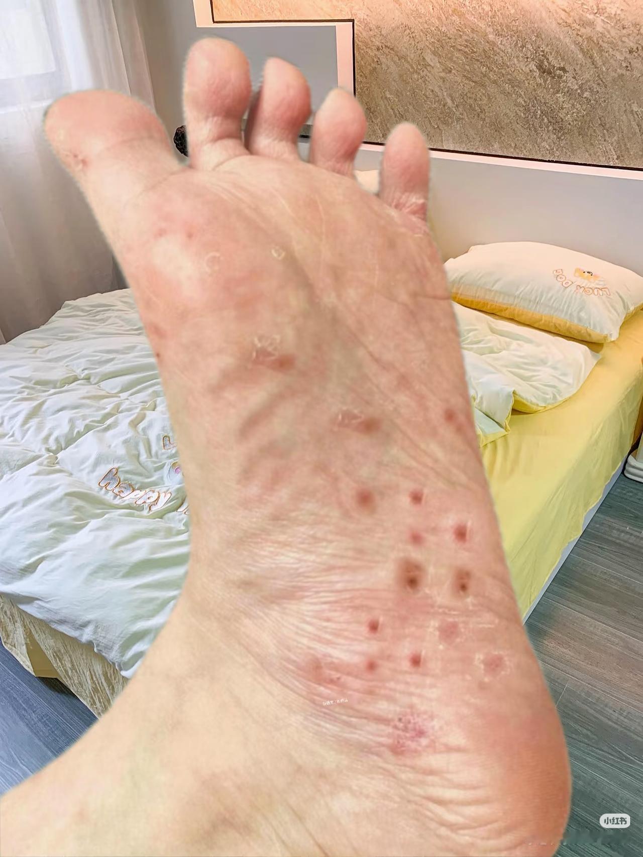 家人们谁懂啊！
脚底板突然冒出一堆小点点，又痒又疼，走路都跟踩针似的，太闹心了！