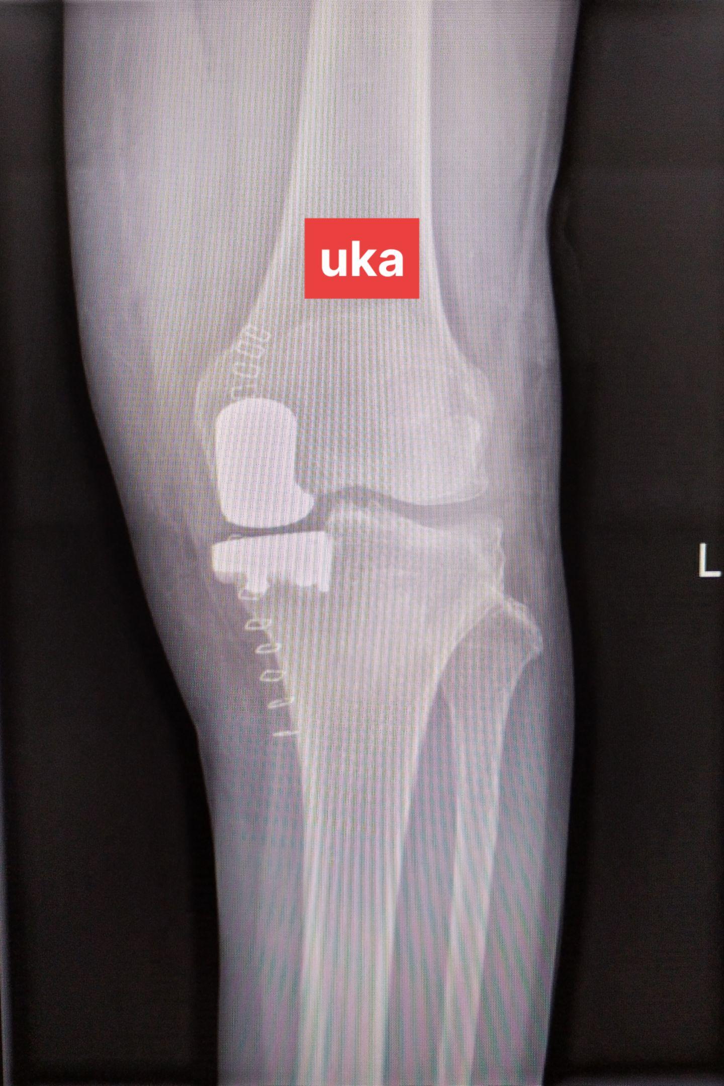 单髁置换术。（看图猜假体）每款假体都有自己的优点，不要单纯追求国产或进口，也不要单纯追求活动平台或固定平台，适合自己才是最好的。愿每一位病人都能快速顺利康复🌹