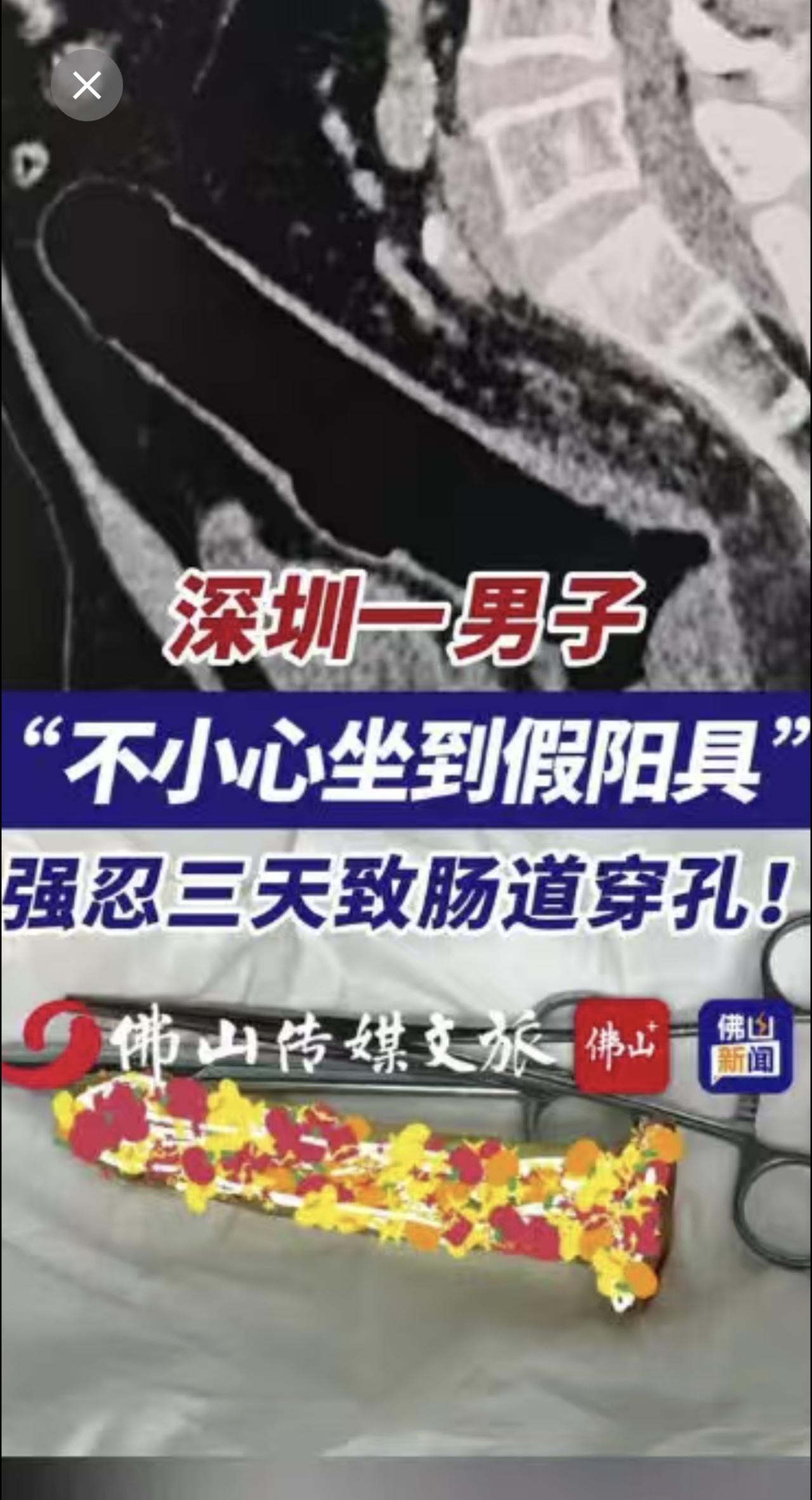 深圳一男子“不小心坐到假阳具”，强忍三天致肠道穿孔！（编辑：甘乐；责编：梁莹；素