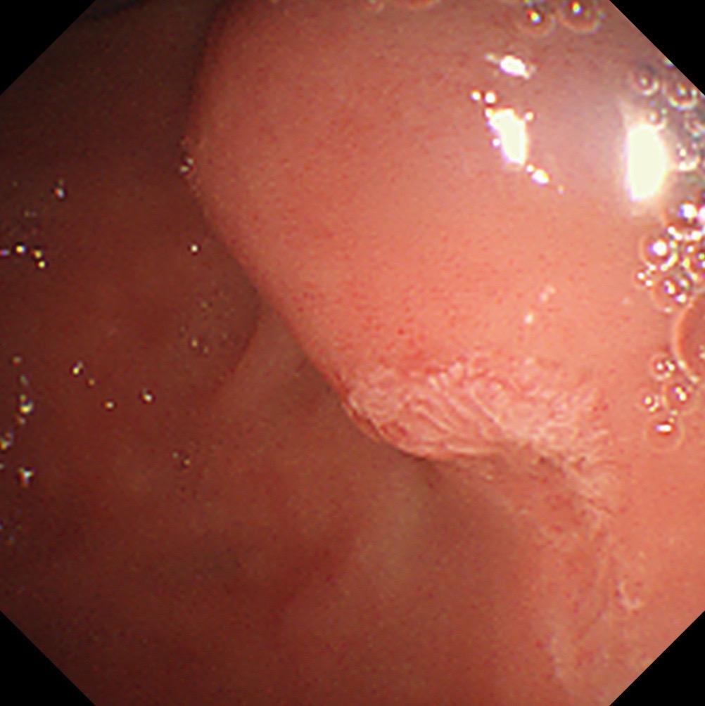 你不是ERCP医生不知道这个手术有多解压。胆管结石嵌顿！