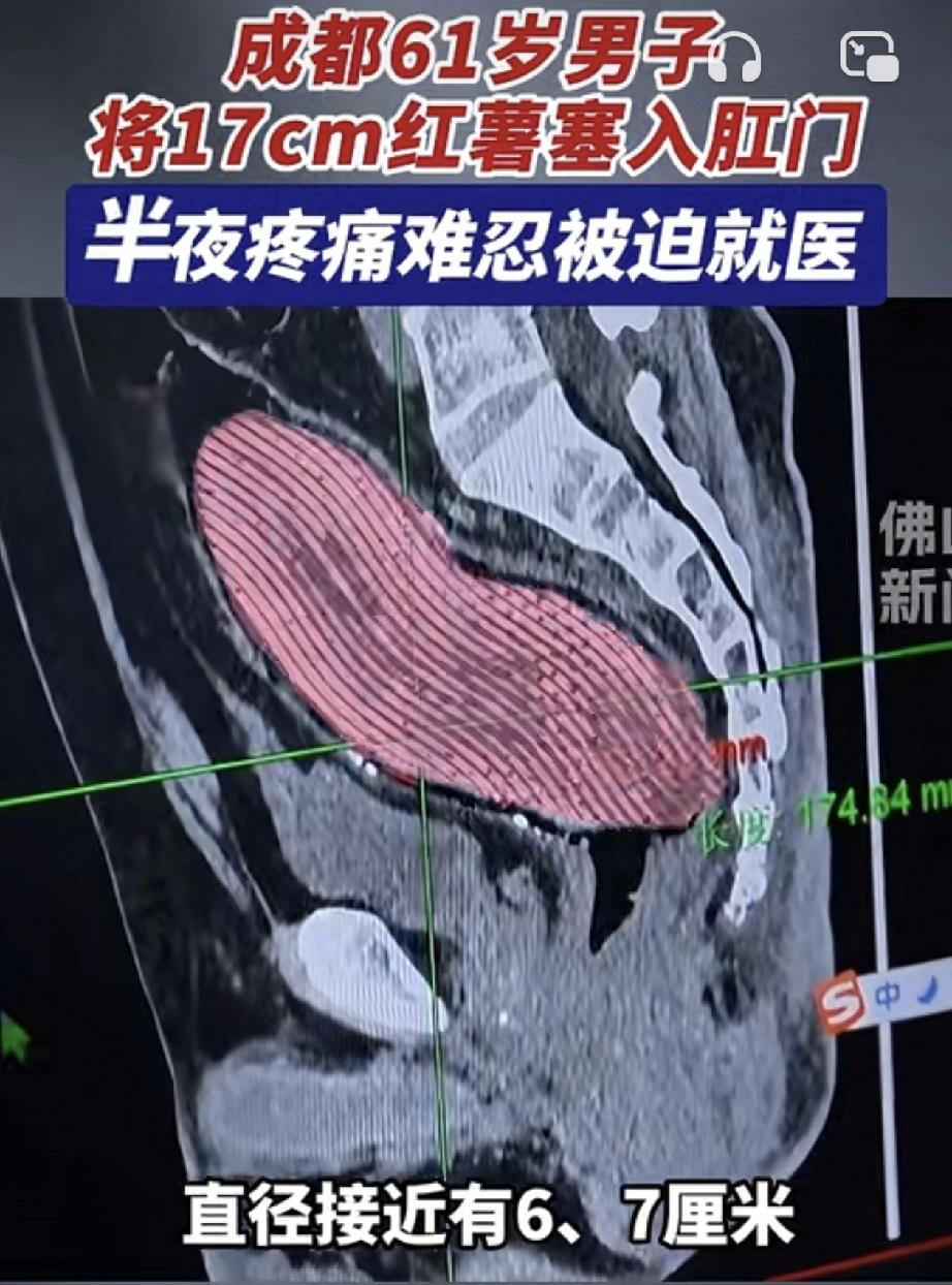 四川成都，一名61岁男子，深夜不知何故，竟自行将一根长约17厘米的大红薯塞进了自