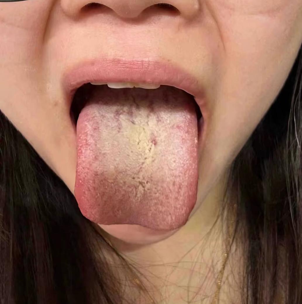 真是大庸医！说你这是湿气重，我听了也很无语[发怒]
患者自述：之前舌苔没这么重，