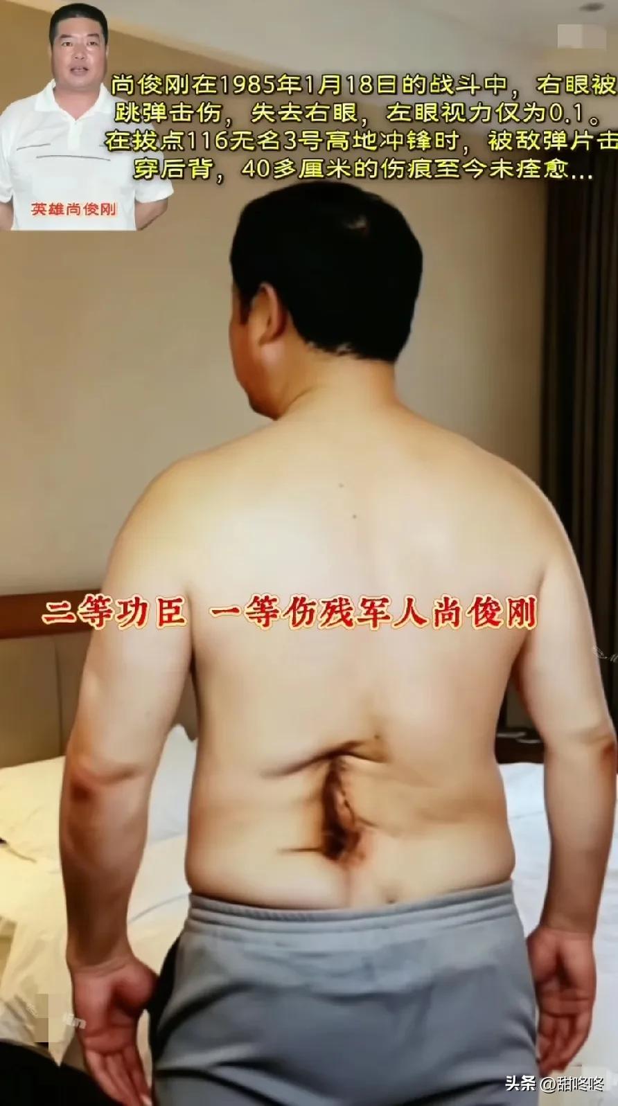 尚俊刚于1985年1月18日的战斗中身负重伤。跳弹击伤其右眼，致使他失去了这只眼