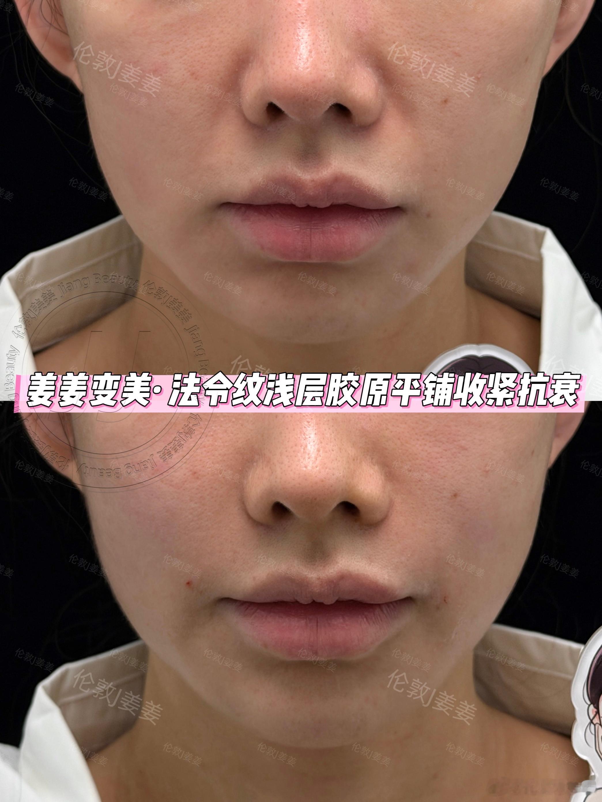 我们的选中案例的第一位锦鲤宝贝，已经打完了这次的💉【艾佰瑞注娇研·胶原蛋白】宝