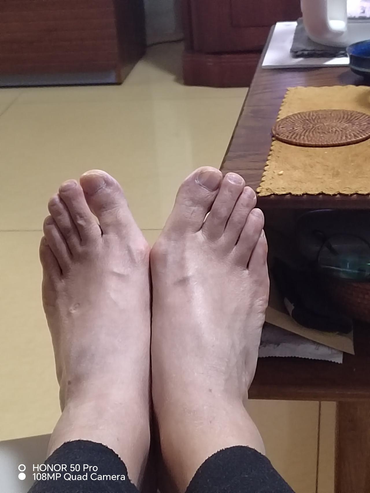 目测夹角在45度～60度之间。这算中度还是重度拇外翻？