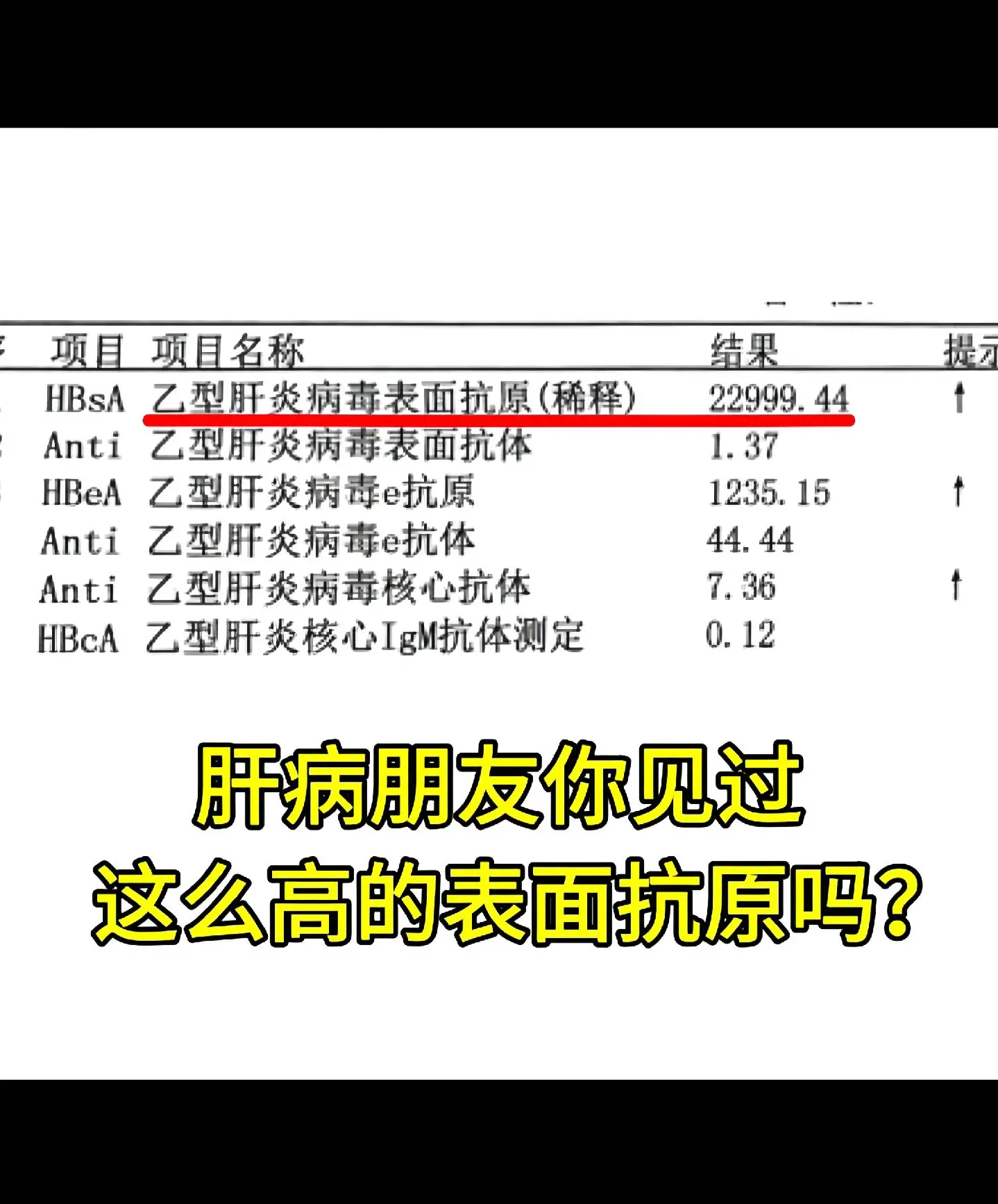 作为一位治肝40多年的老医生提醒大家：像这么高的表面抗原年龄大于30岁...