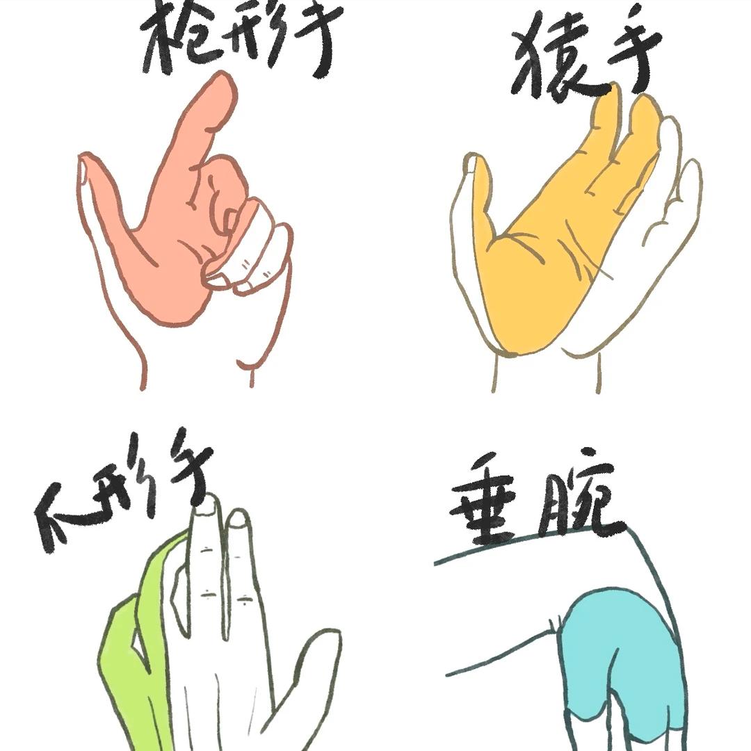 这4种“怪姿态”竟是神经损伤！拖久了可能致残！
 
 
1. 正中神经损伤——猿