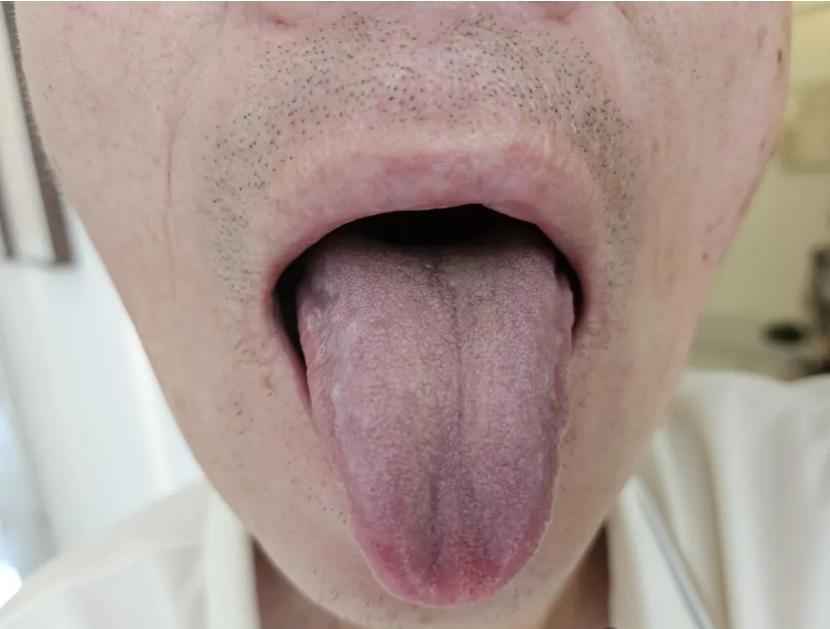 坚持每天看舌诊，你来发，我来看！
   小问题，早看早发现！[谢谢][谢谢][谢