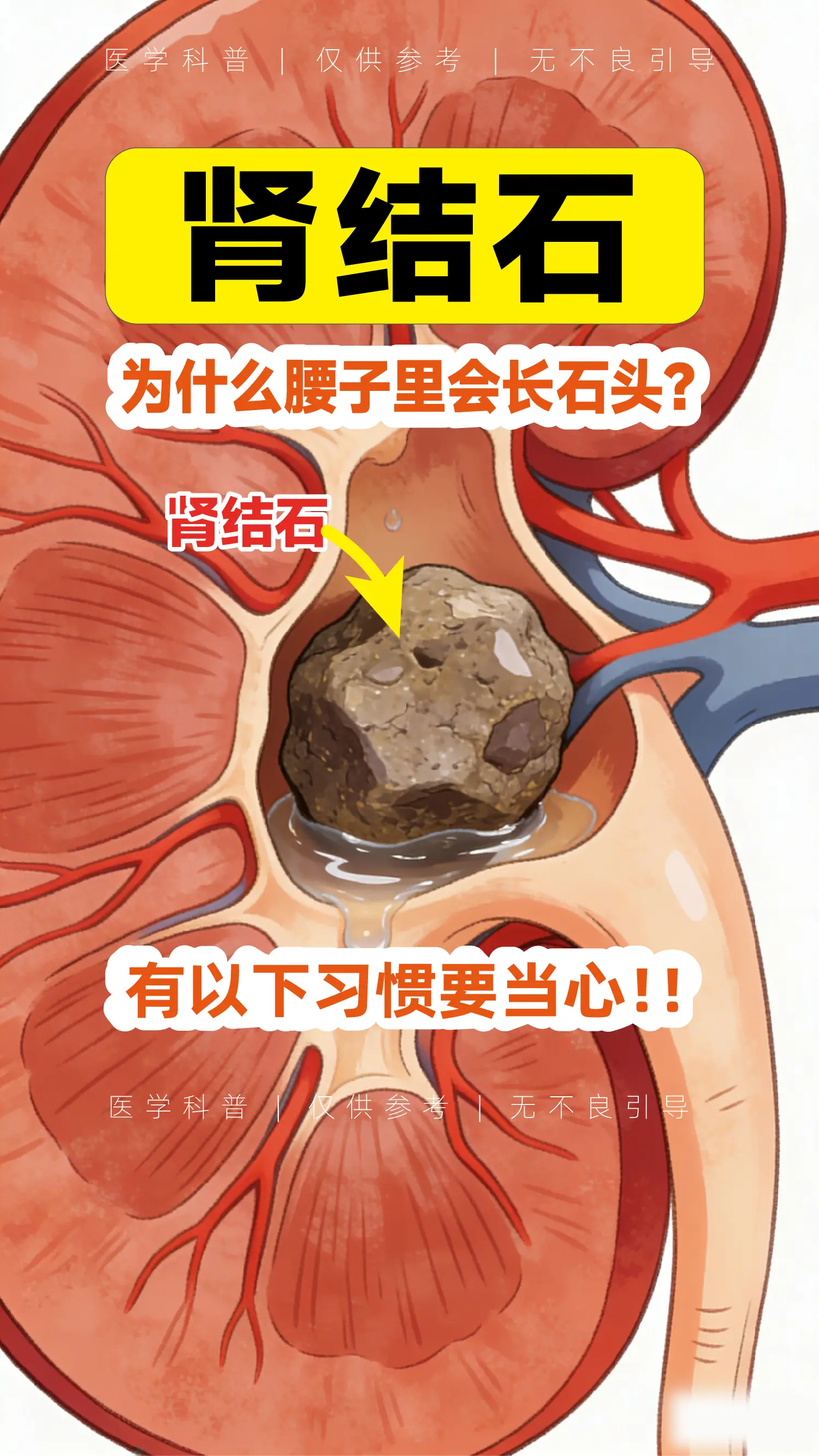 为什么我们的肾脏里会长石头?