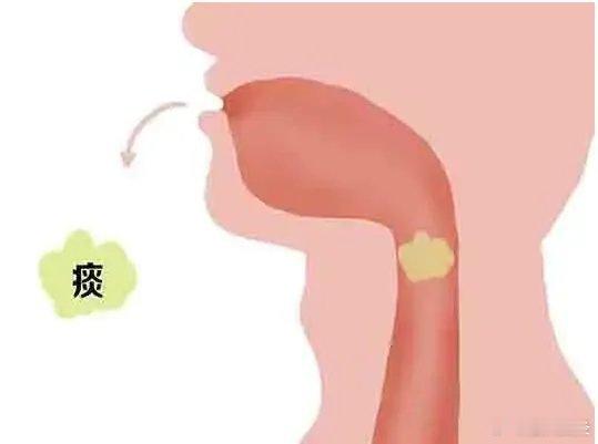 #艾灸后排痰湿有关的反应# 排痰湿多以咳吐，痰变多，呕吐，痰涎或腹痛，腹泻，泄水