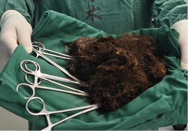 “吃毛癖”的女孩：25岁的佳佳，因为腹胀去做胃镜，没想到医生发现她的胃里有两斤头