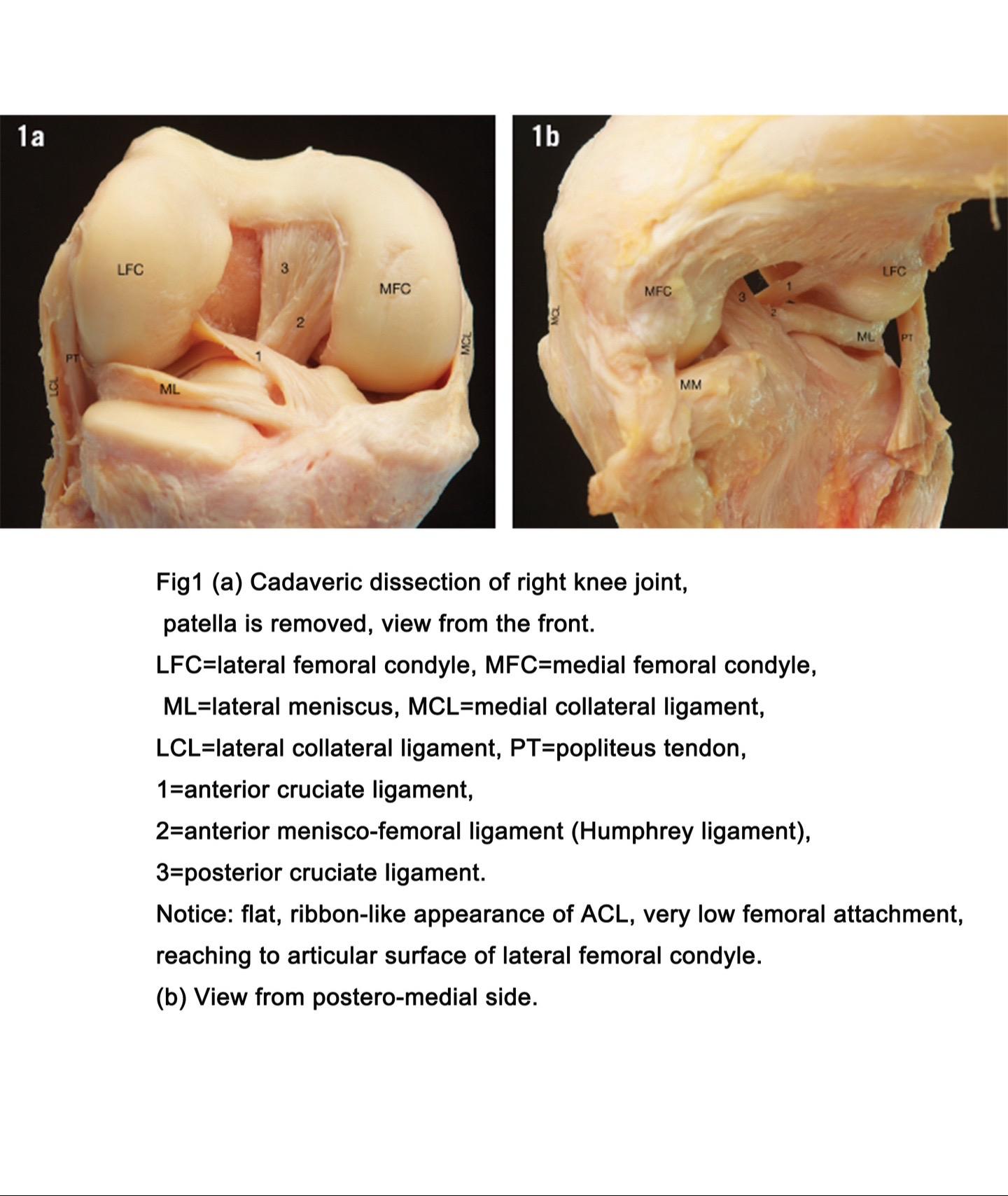 前交叉韧带。前交叉韧带损伤是最常见的损伤之一，全面和详细了解前交叉韧带解剖尤为重要。