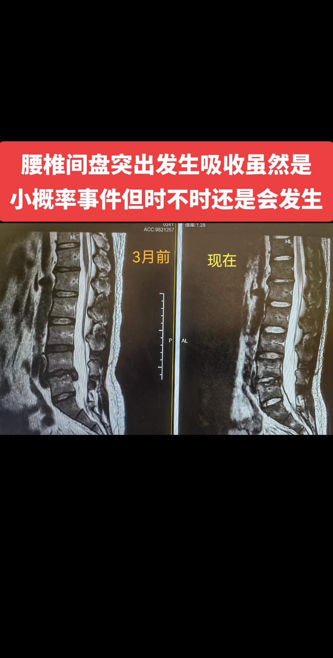 转发我导师昨天发的一个腰椎间盘吸收的病例并配有国际权威期刊《SPINE...