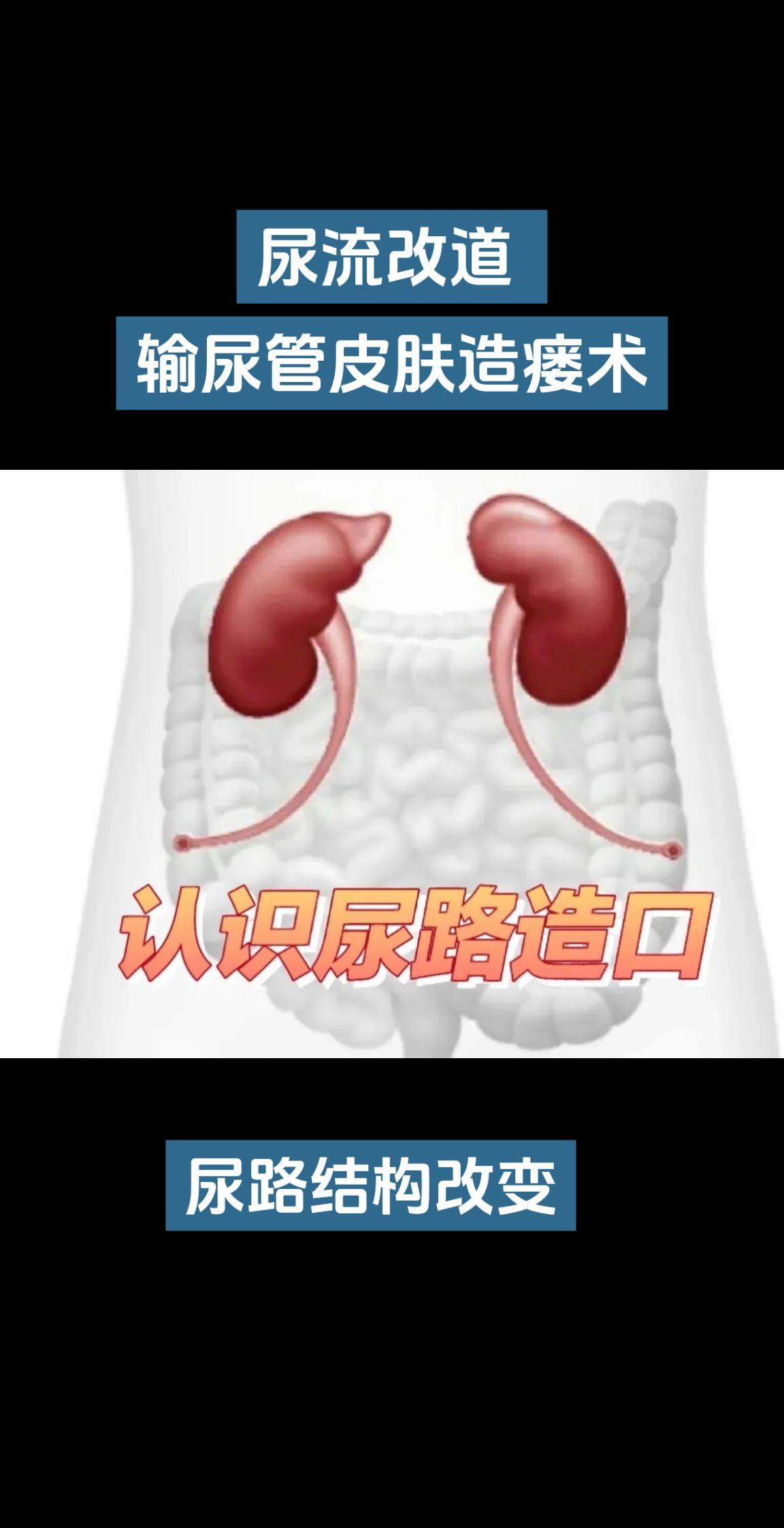 经输尿管皮肤造瘘口输尿管软镜钬激光碎石术