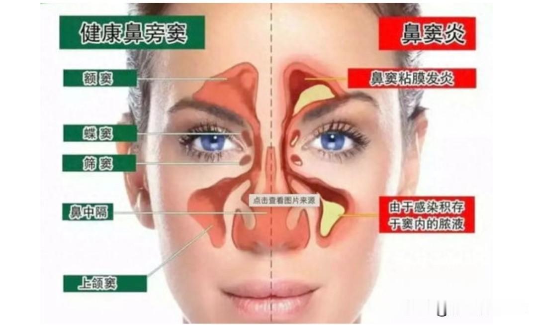 反复鼻塞流涕？5个经典中成药调理慢性鼻炎，温和通窍不刺激，一文读懂
 
慢性鼻炎