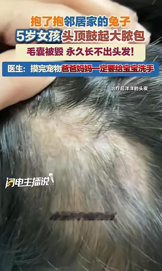 5岁女孩抱完兔子永久性脱发就因为是女孩子，这个"永久性脱发"四个字才更让人心疼。