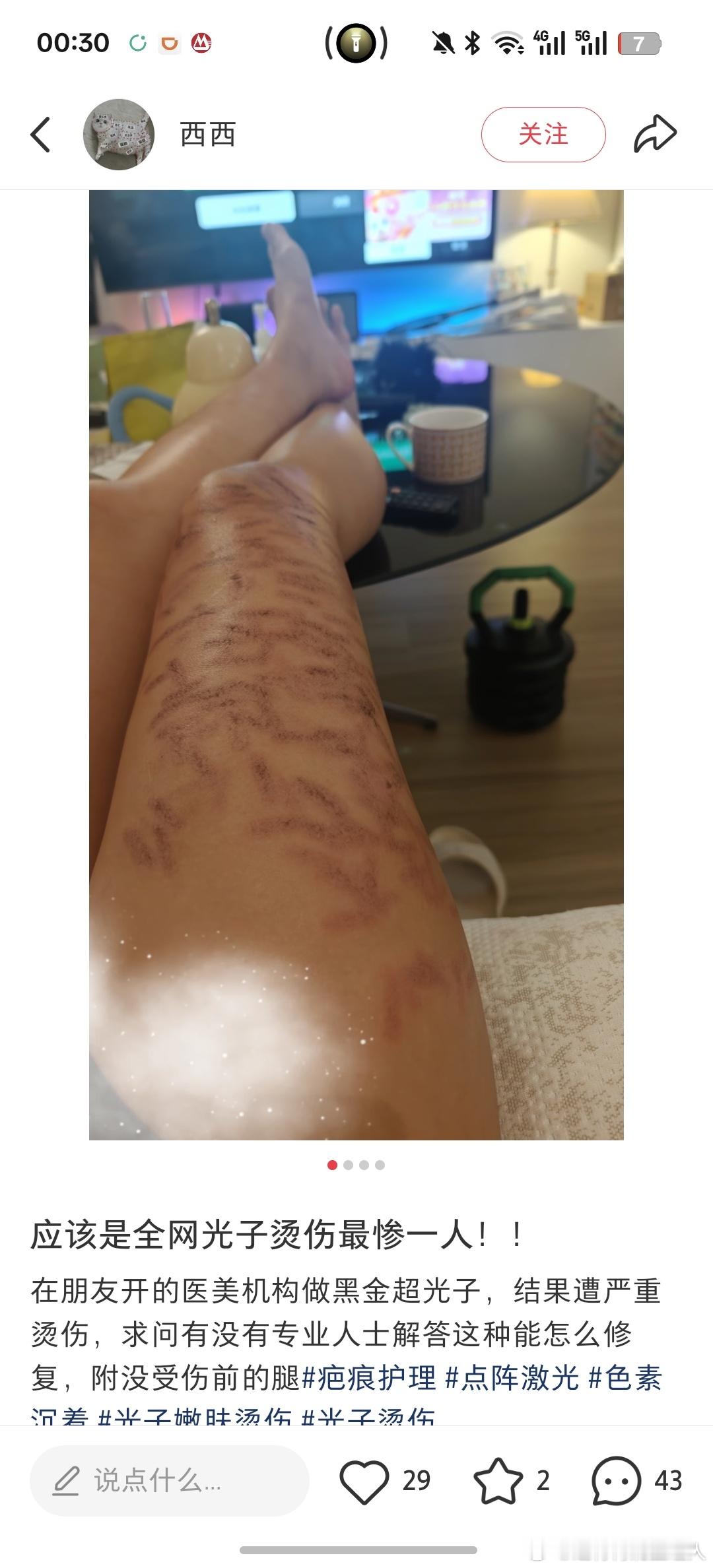 大概率是假货，也不是正经的医美机构光斑覆盖形状像鸡爪子，操作者对技术一窍不通 
