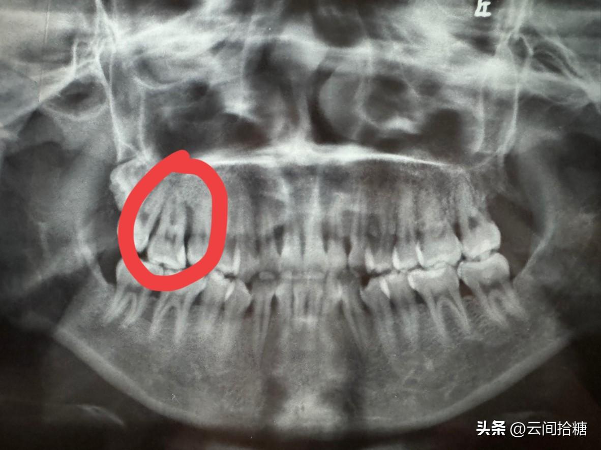 18年前我得的是侵袭性牙周炎，这类牙周炎的核心特点就是青春期前后就开始发病，然后