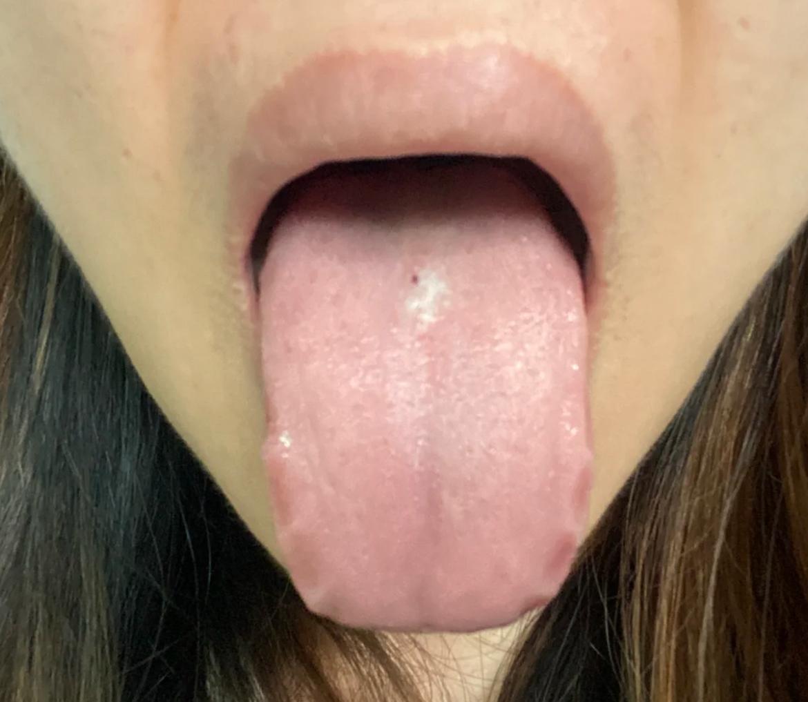 别小看这种齿痕舌，表面脾虚湿盛，实则伴有肝郁
昨天遇到的一位女士，健脾补脾药吃了