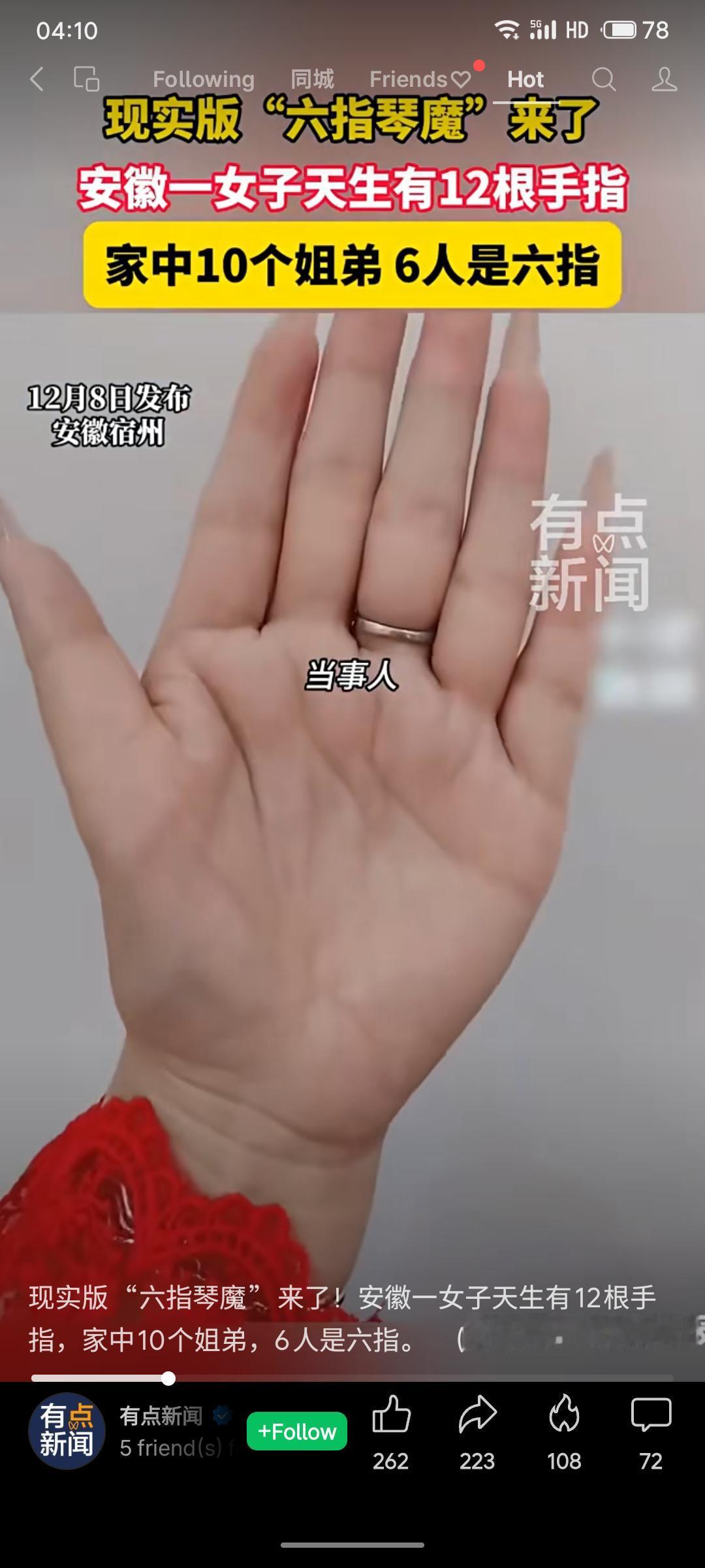 现实版“六指琴魔”登场！安徽一女子天生12指，家中10个姐弟竟有6人是六指，堪称