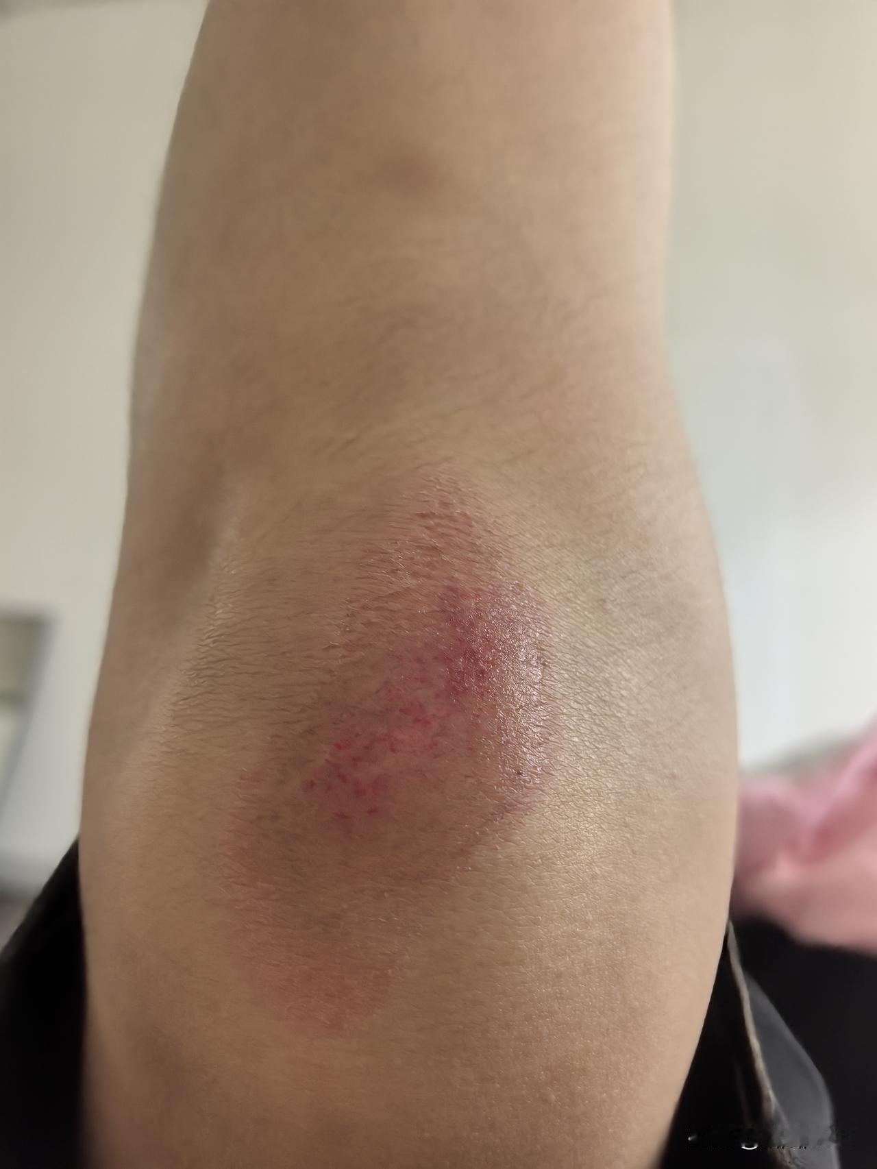 家人们谁懂啊！这膝盖伤口恢复也太“倔强”了！
 
不小心摔了一跤，膝盖就变成这副