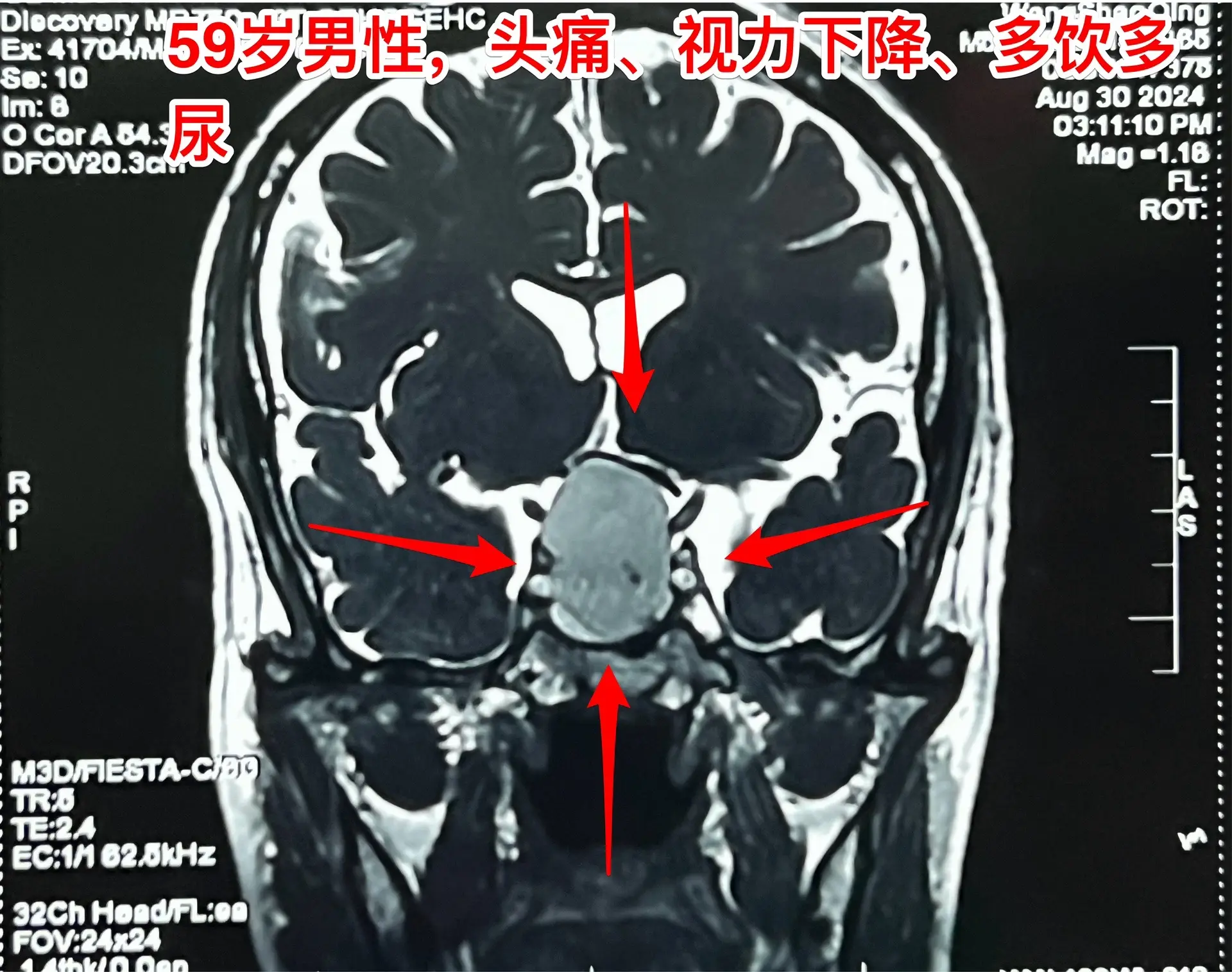 头痛、视力下降、多饮多尿、体重下降。59岁洛阳市男性，近三年感头痛，近...