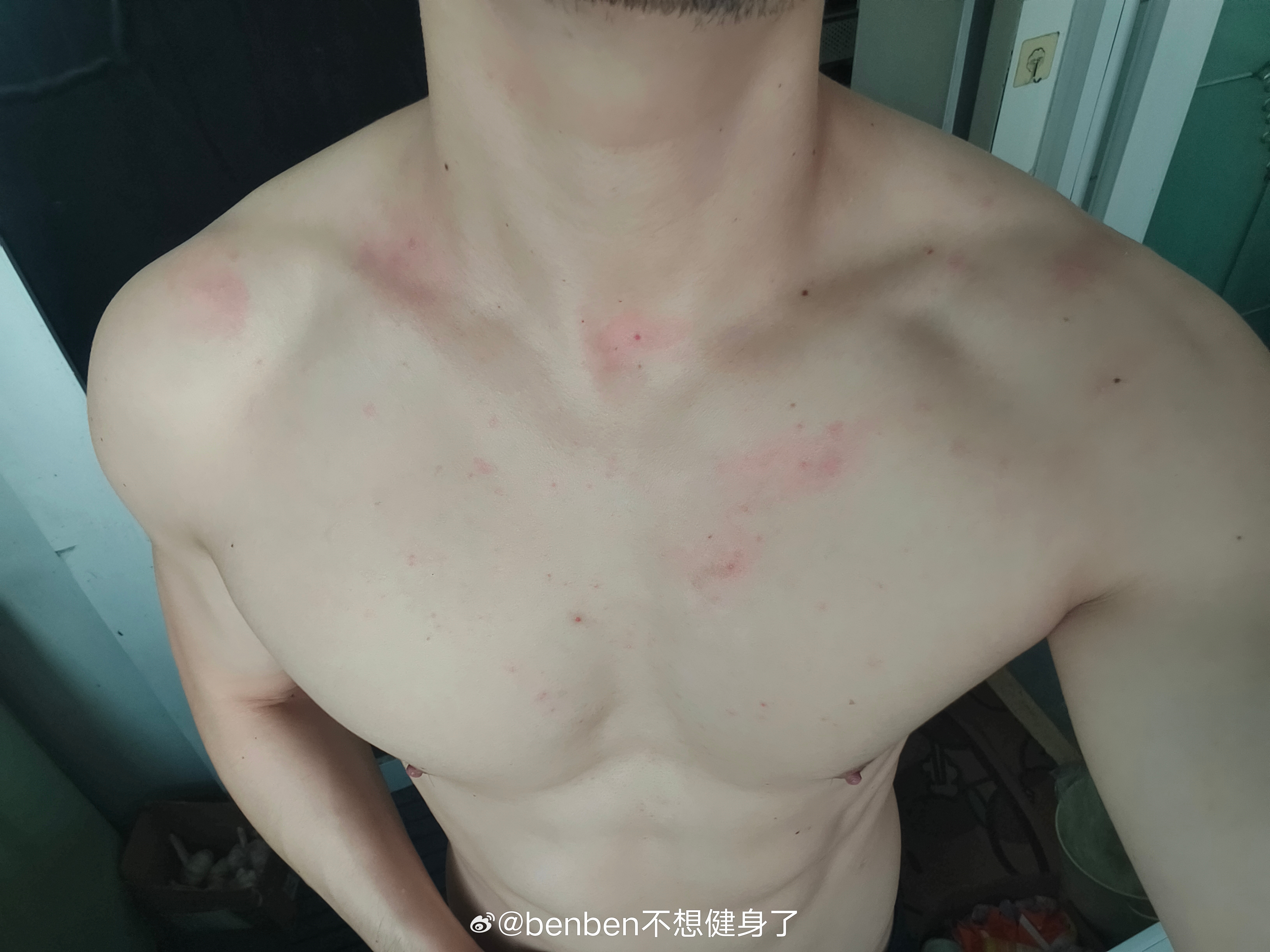 不知道是不是最近上火的零食吃多了，还是闷出痱子了，还是酒精过敏的…身上长了好多痘