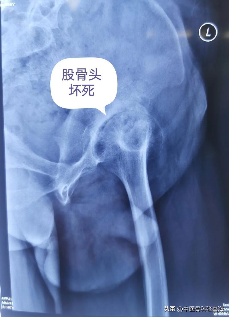 行医40年，实话实说：股骨头坏死到底能不能“自愈”？
“医生，我听说有人股骨头坏