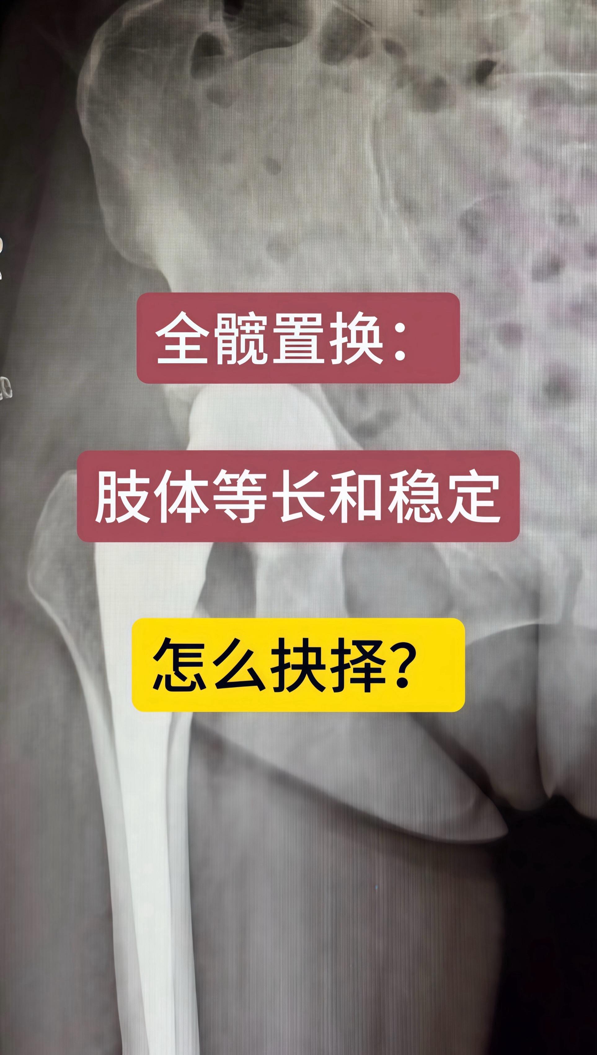 60岁女性，股骨颈骨折全髋置换。术中发现如果以稳定为主，需要放加长头...