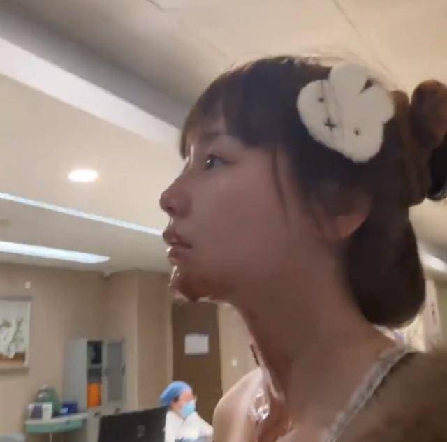 演员生日蛋糕喷火被烧伤生日变惊魂！王添羽为拍大片用高浓度酒精喷火，火焰失控致面部